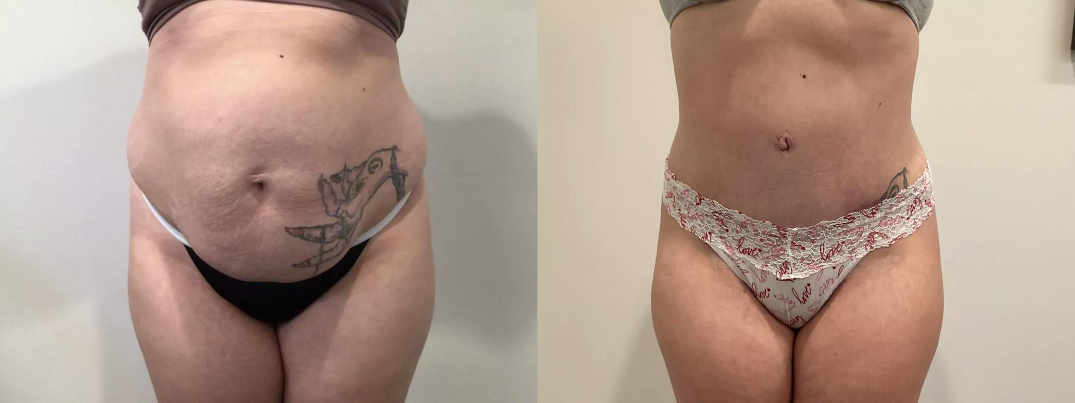 Tummy Tuck Before & After Gallery - Patient 351274 - Image 1