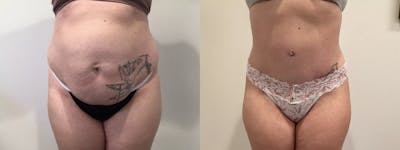 Tummy Tuck Before & After Gallery - Patient 351274 - Image 1