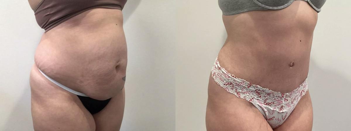 Tummy Tuck Before & After Gallery - Patient 351274 - Image 2