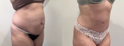 Tummy Tuck Before & After Gallery - Patient 351274 - Image 2
