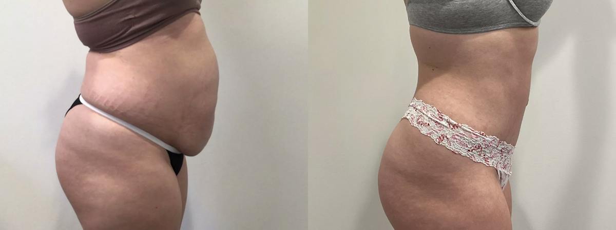 Tummy Tuck Before & After Gallery - Patient 351274 - Image 3