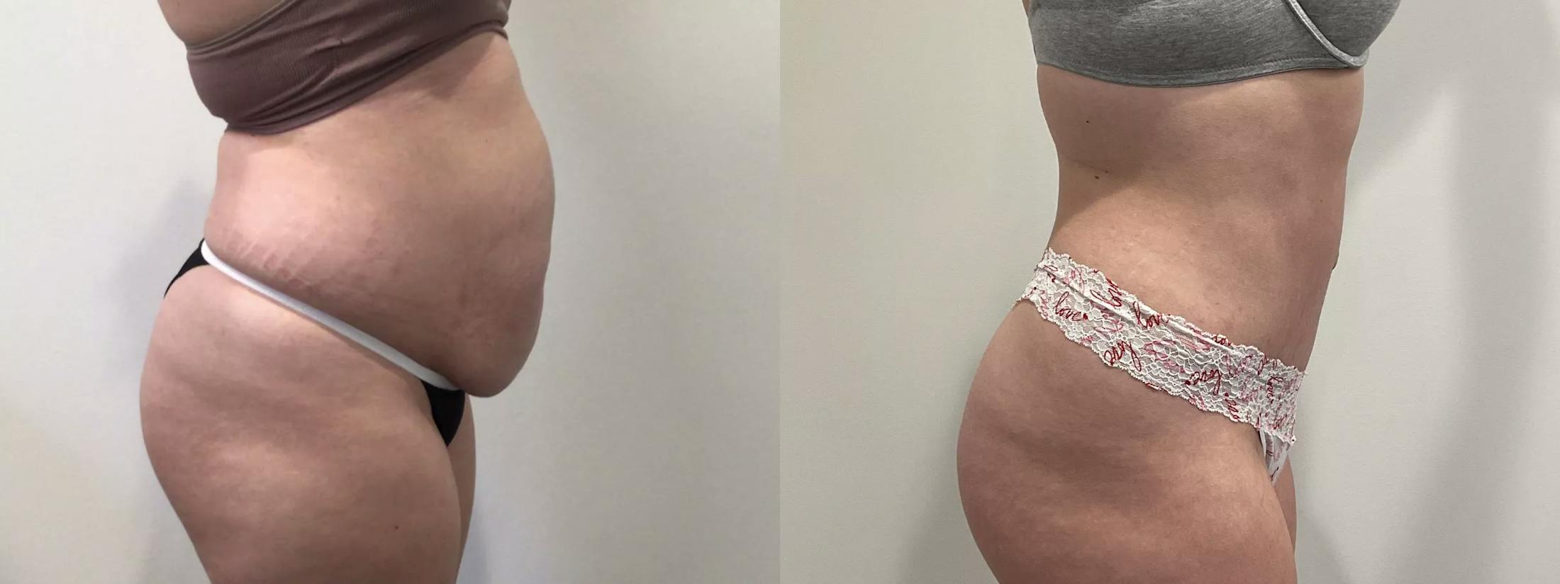 Tummy Tuck Before & After Gallery - Patient 351274 - Image 3