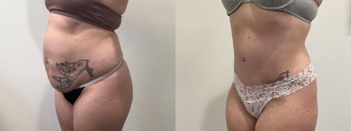 Tummy Tuck Before & After Gallery - Patient 351274 - Image 4