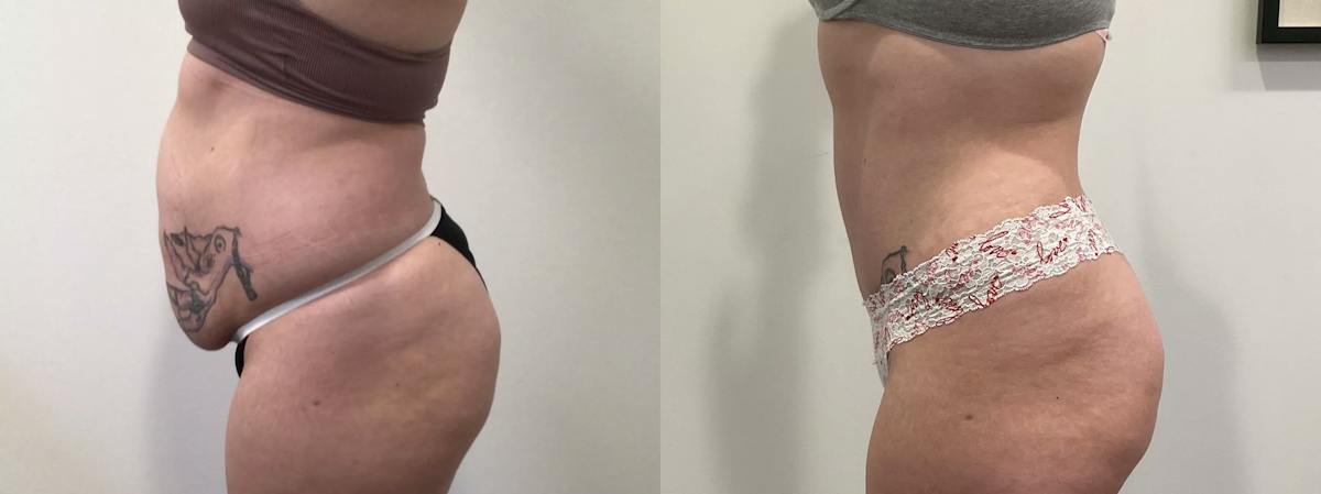 Tummy Tuck Before & After Gallery - Patient 351274 - Image 5