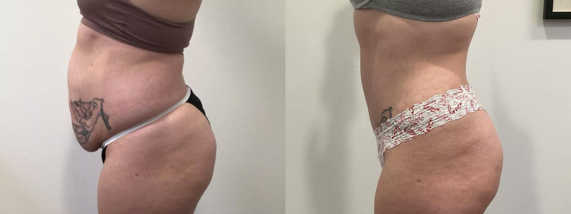 Tummy Tuck Before & After Gallery - Patient 351274 - Image 5