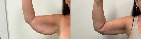 Arm Lift Before & After Gallery - Patient 205001 - Image 1
