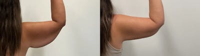 Arm Lift Before & After Gallery - Patient 205001 - Image 2