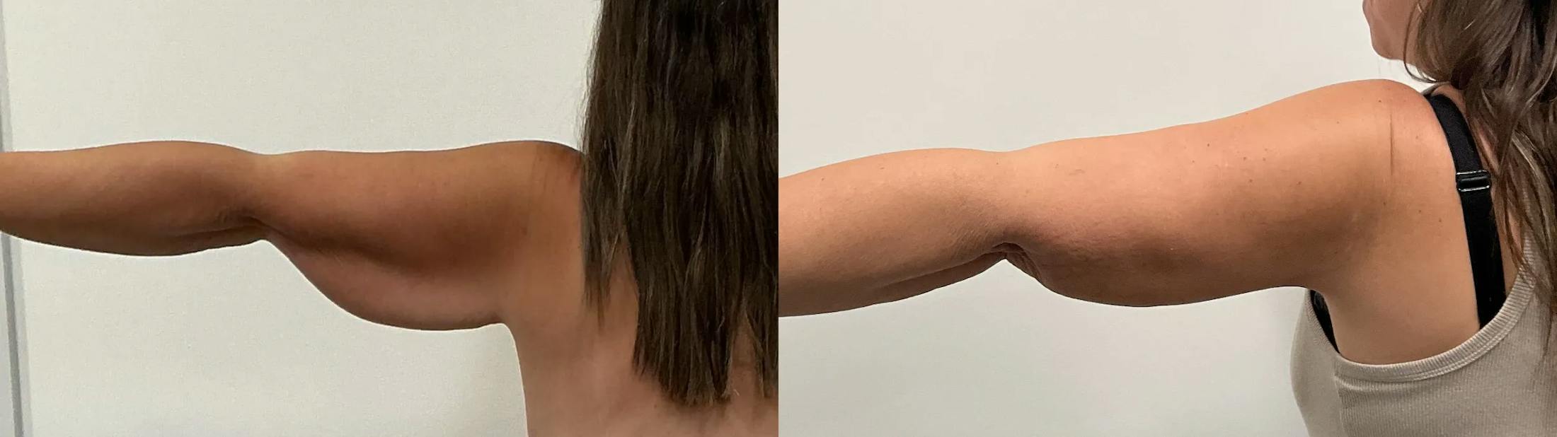 Arm Lift Before & After Gallery - Patient 205001 - Image 3