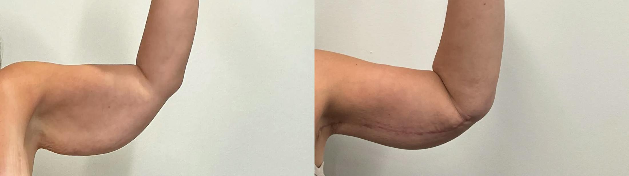 Arm Lift Before & After Gallery - Patient 205001 - Image 4