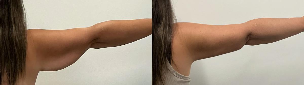 Arm Lift Before & After Gallery - Patient 205001 - Image 5