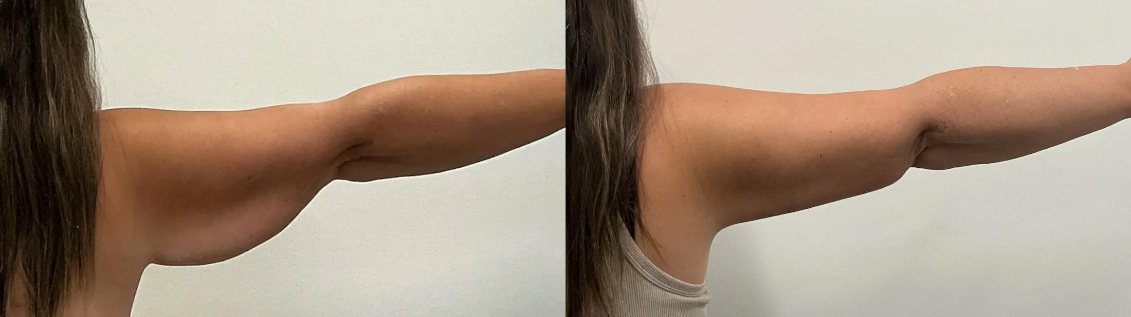 Arm Lift Before & After Gallery - Patient 205001 - Image 5