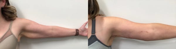 Arm Lift Before & After Gallery - Patient 385186 - Image 1