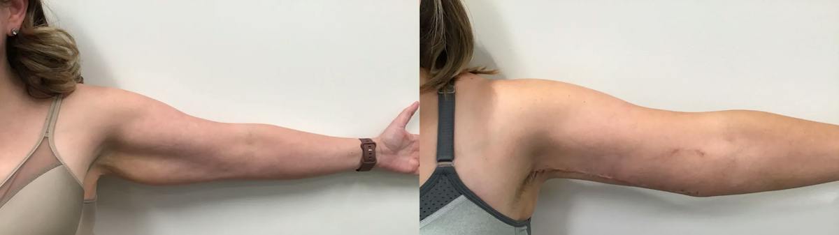 Arm Lift Before & After Gallery - Patient 385186 - Image 1