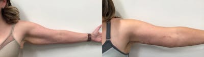 Arm Lift Before & After Gallery - Patient 385186 - Image 1