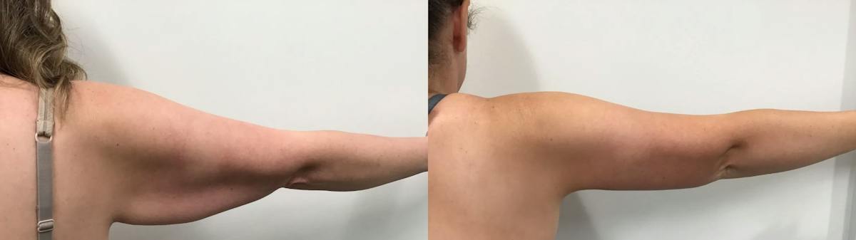 Arm Lift Before & After Gallery - Patient 385186 - Image 3