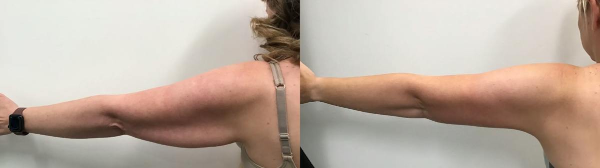 Arm Lift Before & After Gallery - Patient 385186 - Image 4