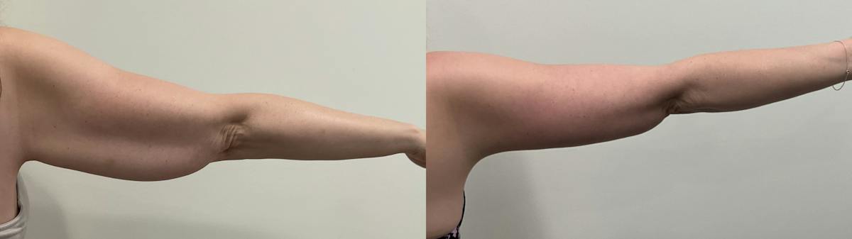 Arm Lift Before & After Gallery - Patient 290865 - Image 1