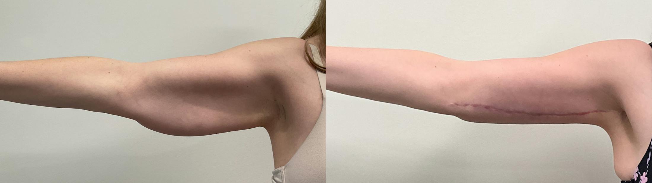 Arm Lift Before & After Gallery - Patient 290865 - Image 2