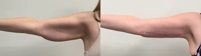 Arm Lift Before & After Gallery - Patient 290865 - Image 2