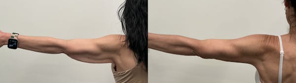 Arm Lift Before & After Gallery - Patient 368755 - Image 1