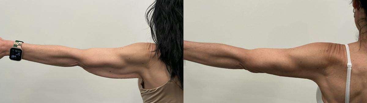 Arm Lift Before & After Gallery - Patient 368755 - Image 1