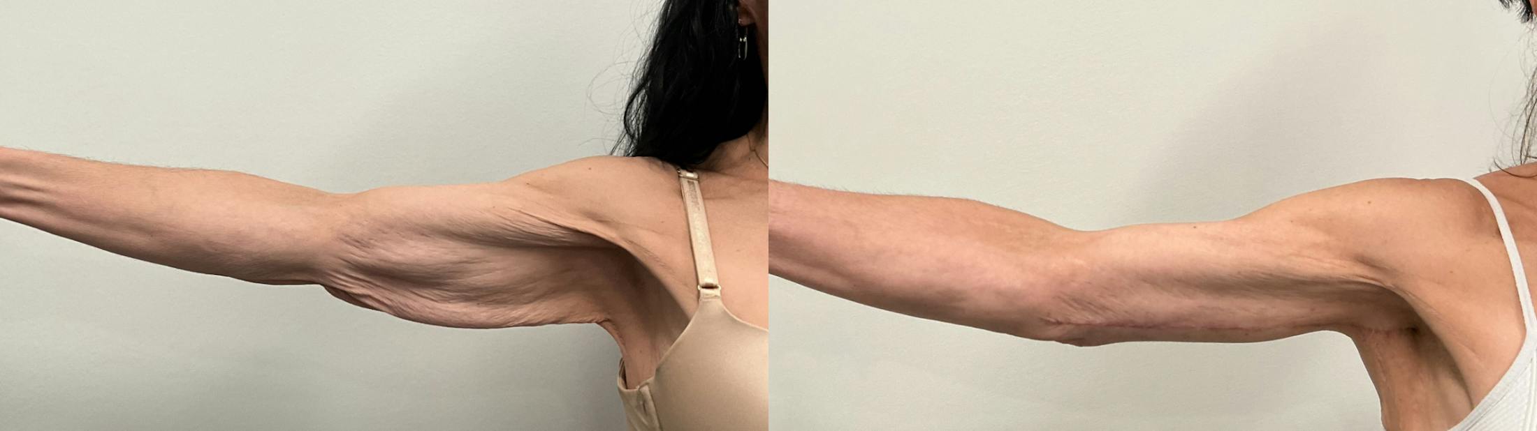 Arm Lift Before & After Gallery - Patient 368755 - Image 2