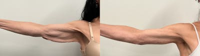 Arm Lift Before & After Gallery - Patient 368755 - Image 2