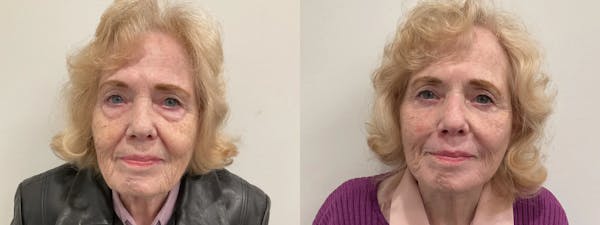 Eyelid Surgery Before & After Gallery - Patient 116429 - Image 1