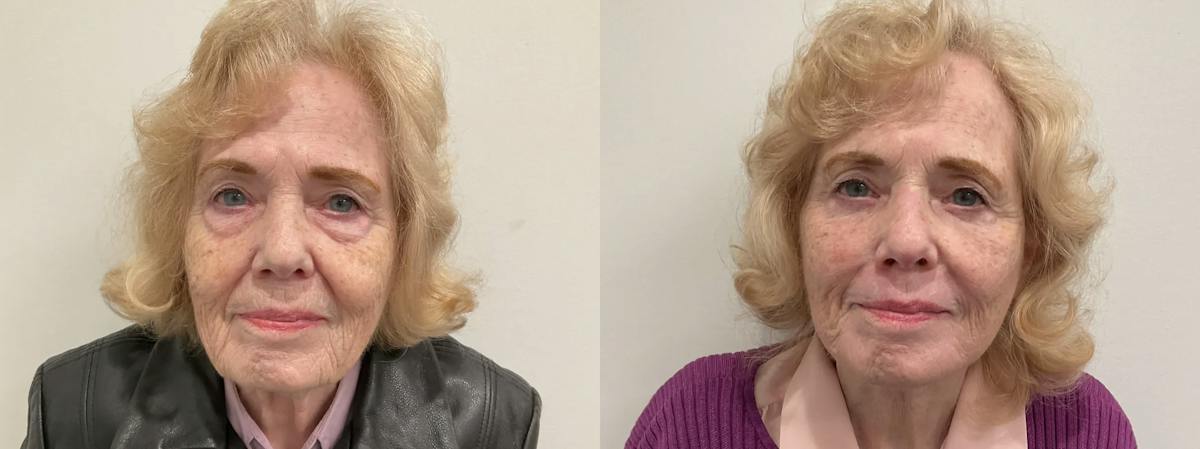 Eyelid Surgery Before & After Gallery - Patient 116429 - Image 1