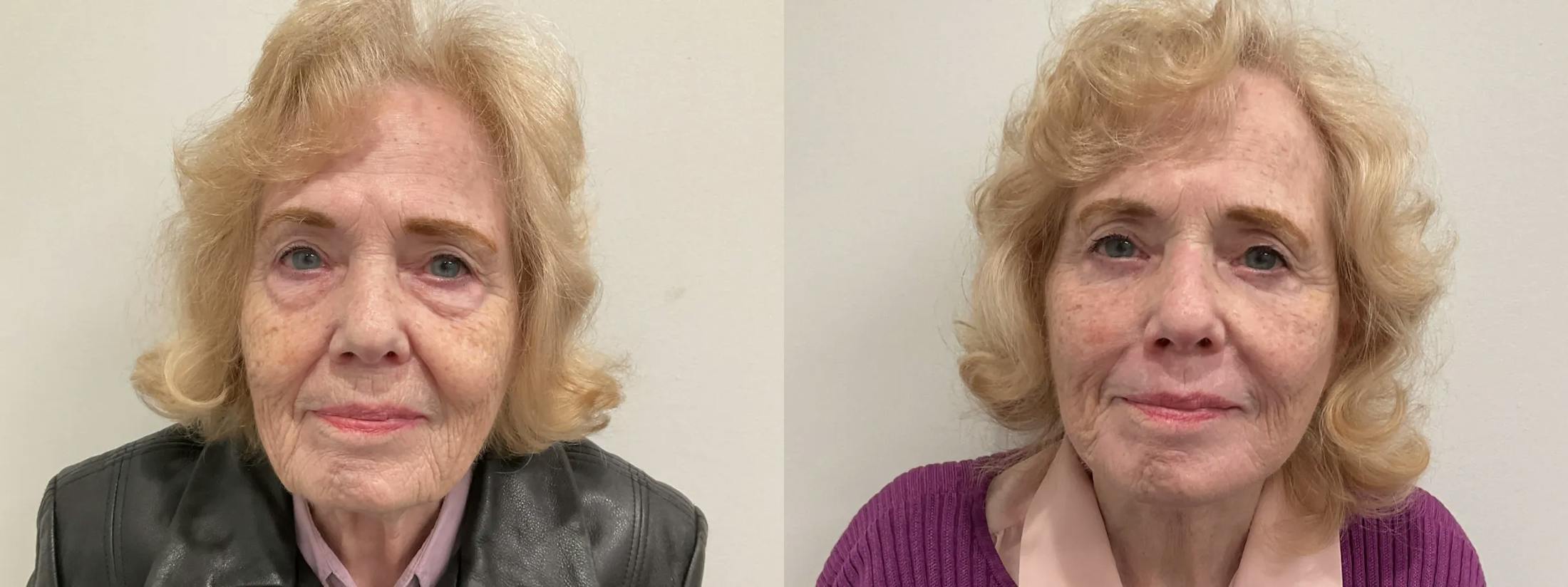 Eyelid Surgery Before & After Gallery - Patient 116429 - Image 1