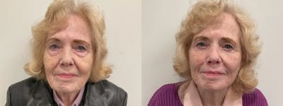 Facelift Before & After Gallery - Patient 123667 - Image 1