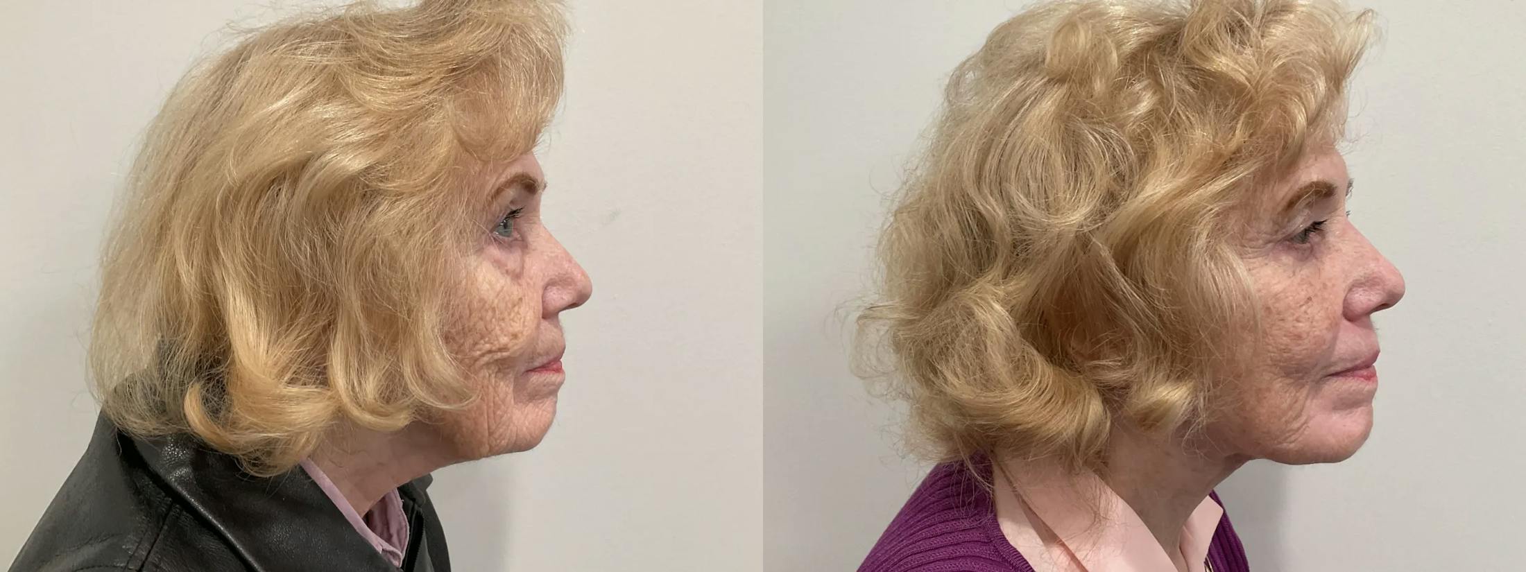 Eyelid Surgery Before & After Gallery - Patient 116429 - Image 2