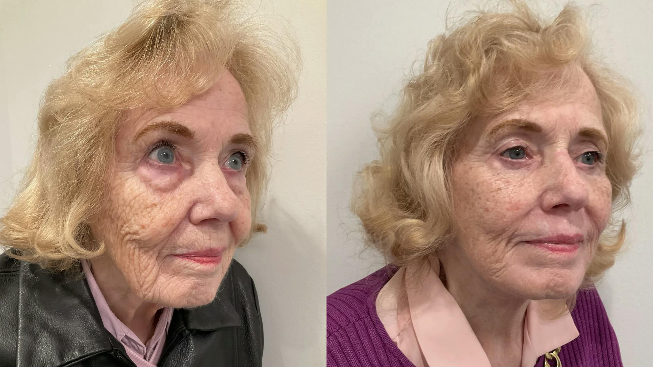 Eyelid Surgery Before & After Gallery - Patient 116429 - Image 3
