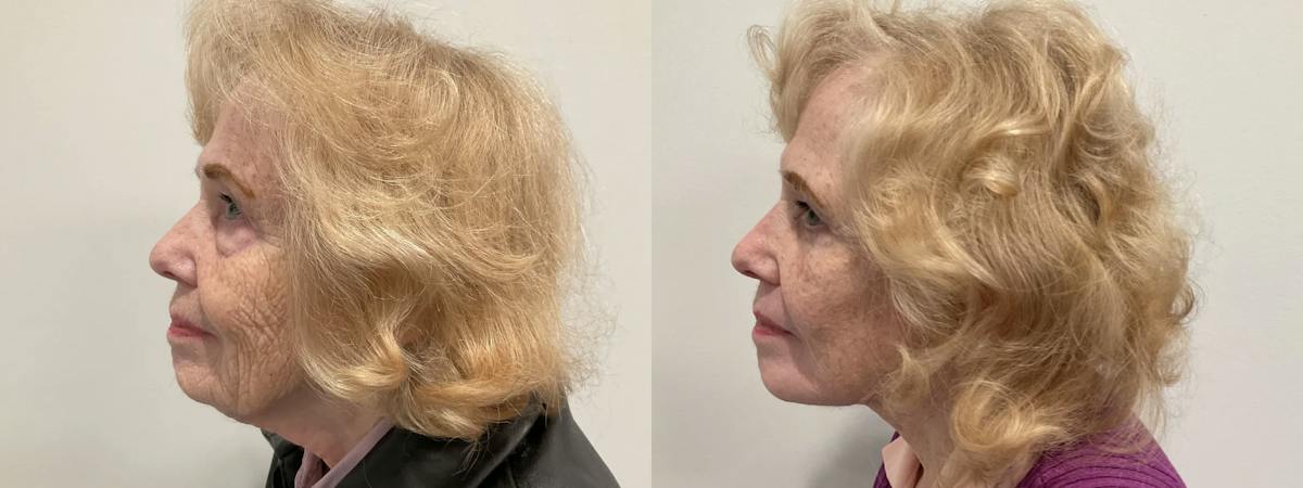 Eyelid Surgery Before & After Gallery - Patient 116429 - Image 4