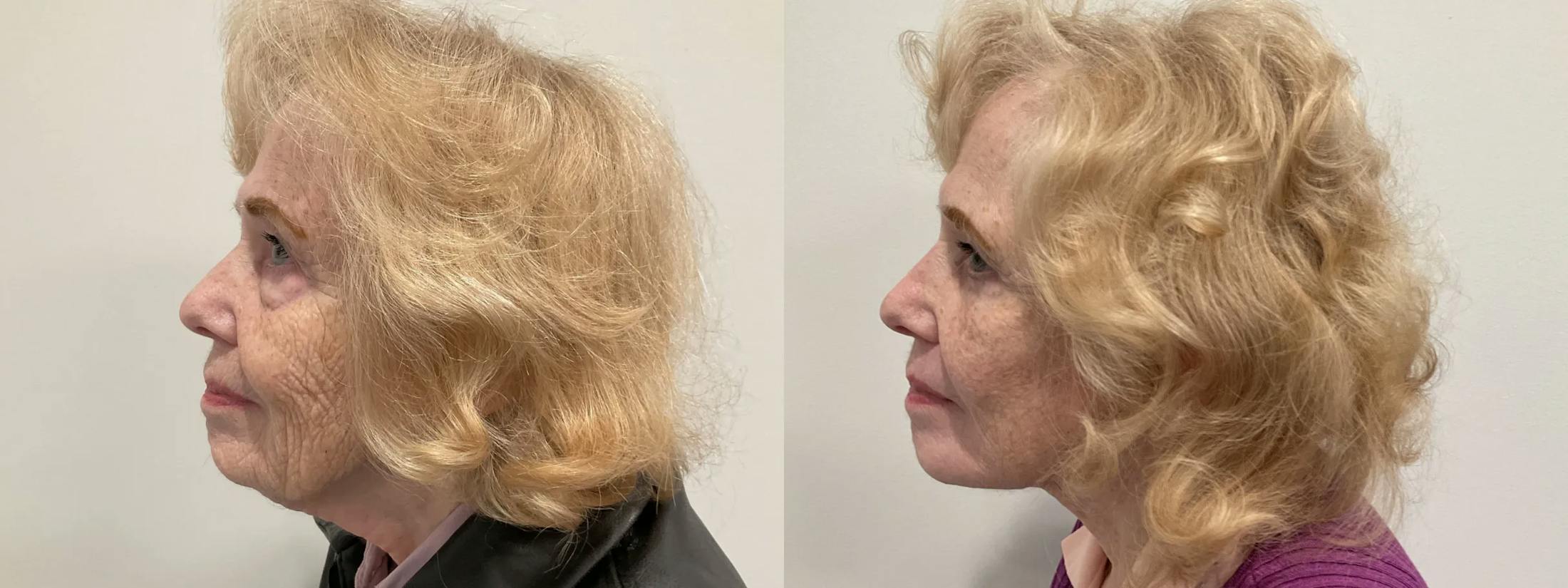 Eyelid Surgery Before & After Gallery - Patient 116429 - Image 4