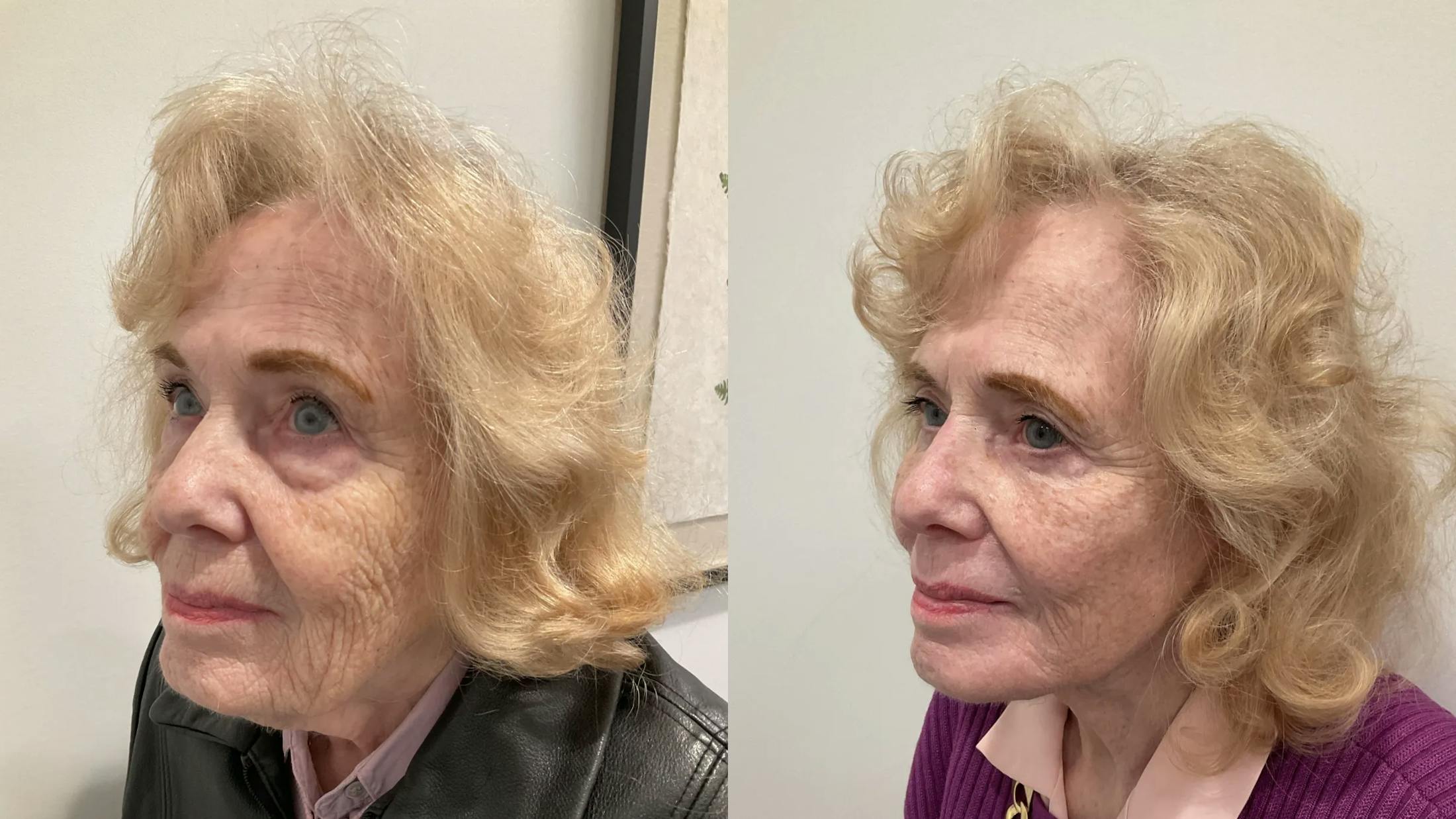 Eyelid Surgery Before & After Gallery - Patient 116429 - Image 5