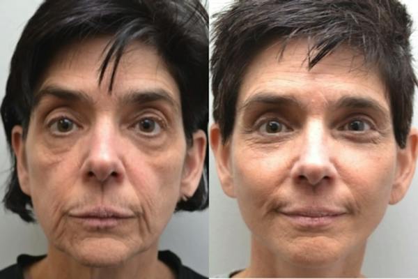 Eyelid Surgery Before & After Gallery - Patient 326500 - Image 1