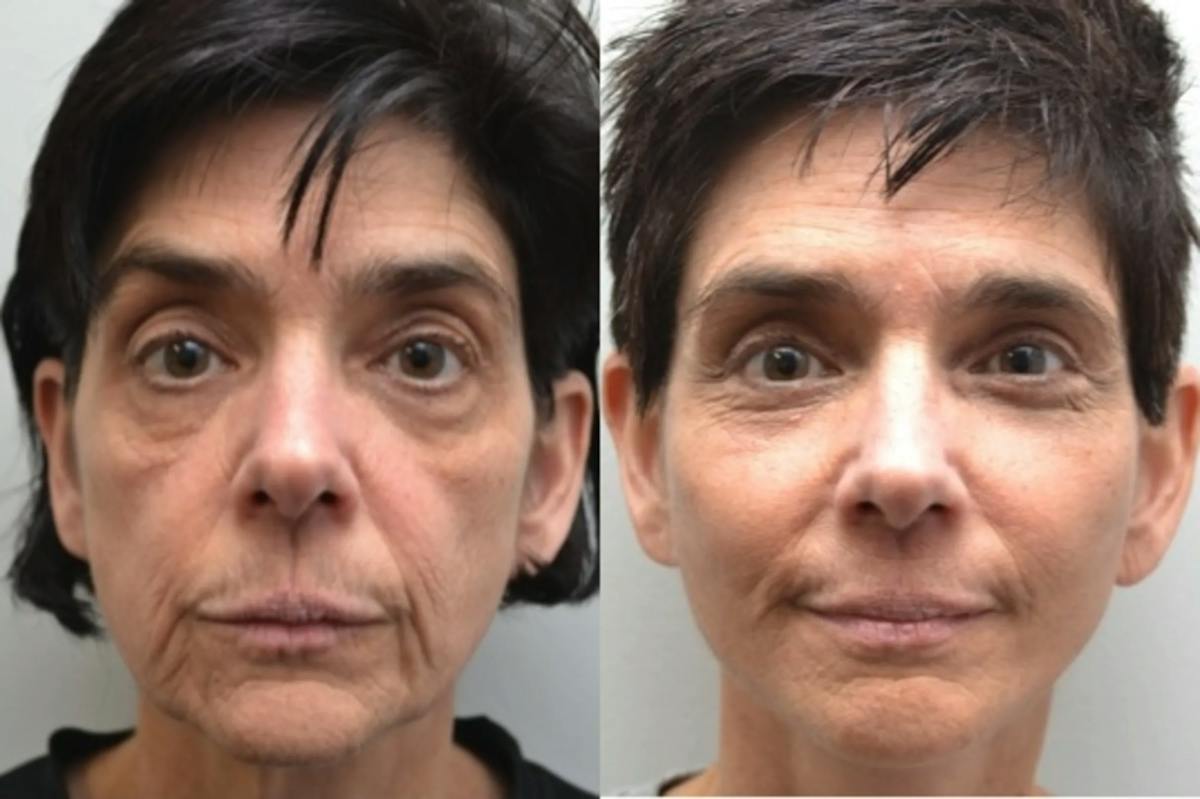Facelift Before & After Gallery - Patient 320467 - Image 1
