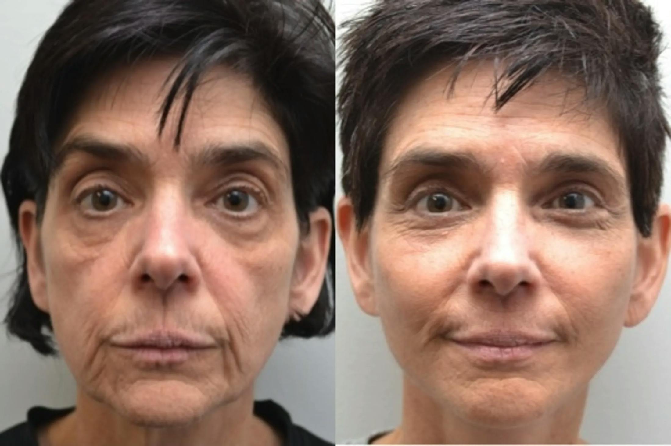 Facelift Before & After Gallery - Patient 320467 - Image 1