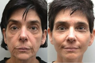 Facelift Before & After Gallery - Patient 320467 - Image 1