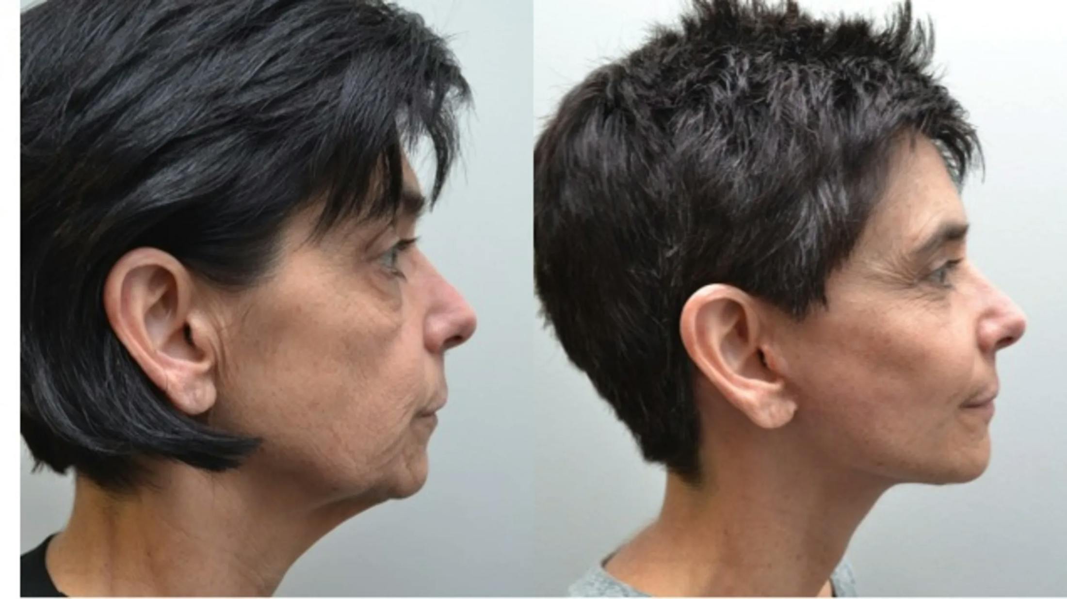 Facelift Before & After Gallery - Patient 320467 - Image 2