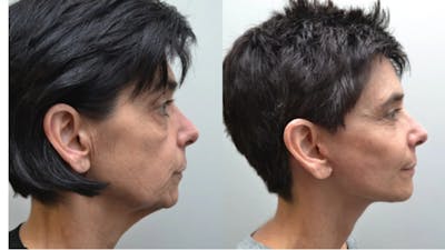Facelift Before & After Gallery - Patient 320467 - Image 2