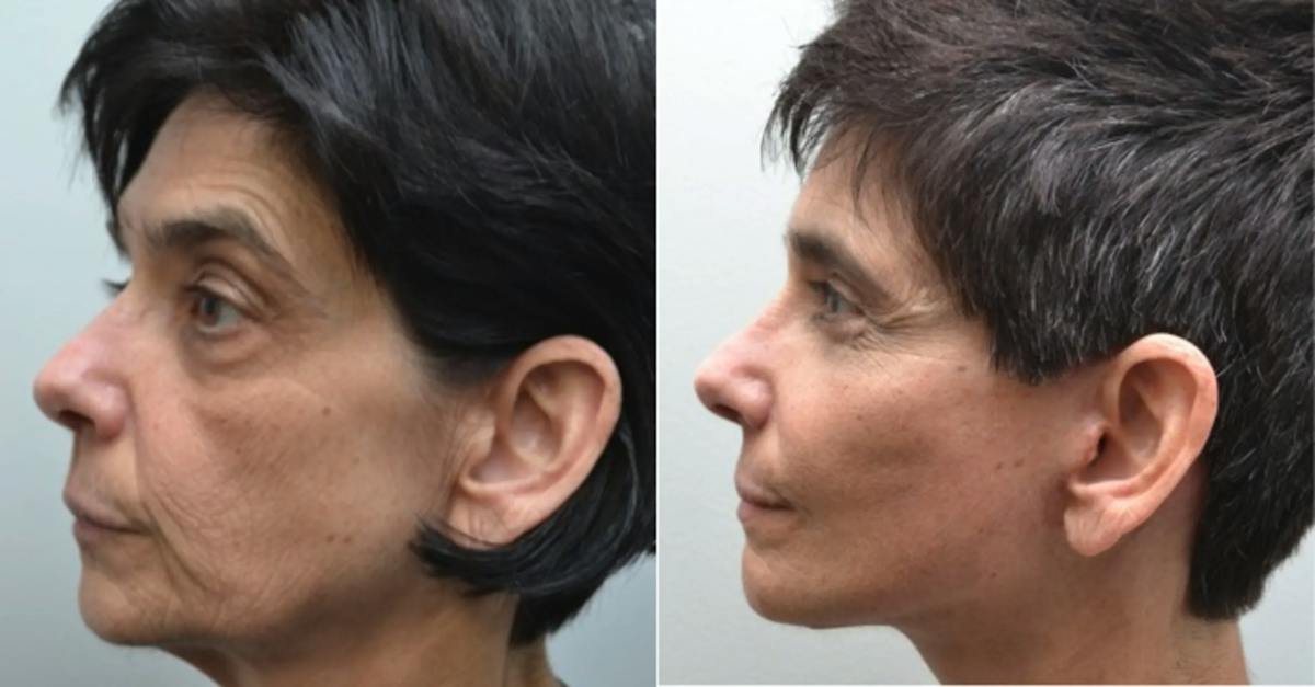 Facelift Before & After Gallery - Patient 320467 - Image 3
