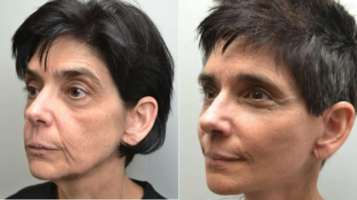 Facelift Before & After Gallery - Patient 320467 - Image 4