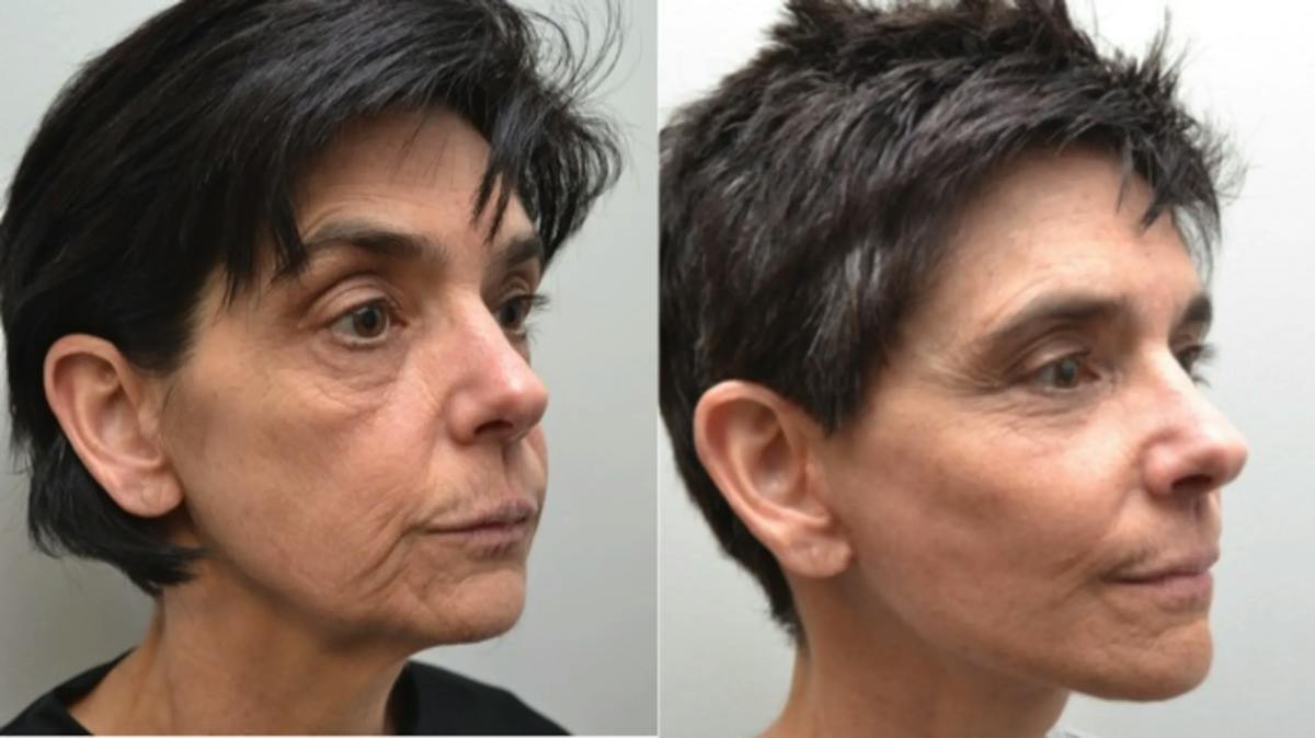 Facelift Before & After Gallery - Patient 320467 - Image 5