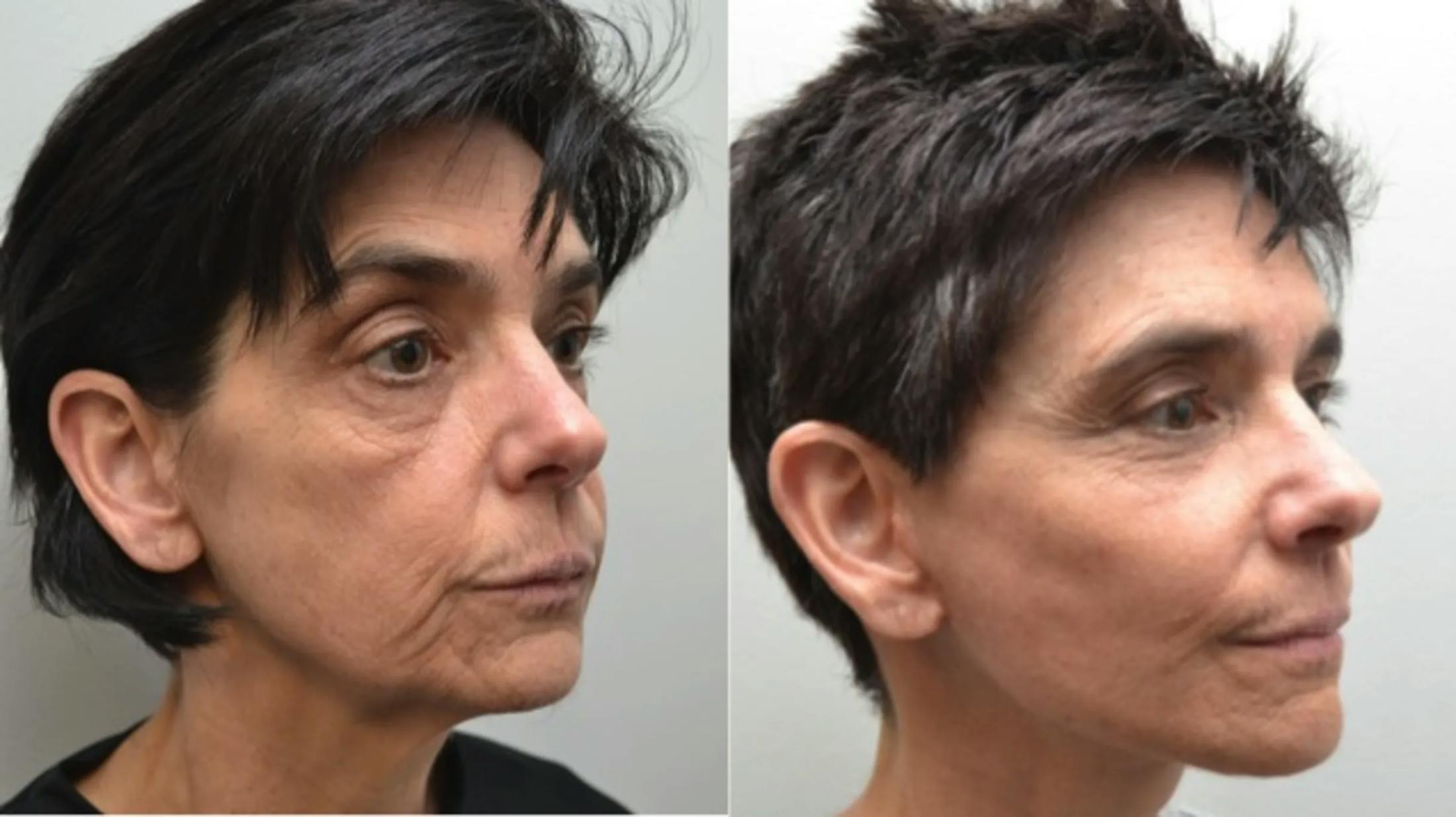 Facelift Before & After Gallery - Patient 320467 - Image 5