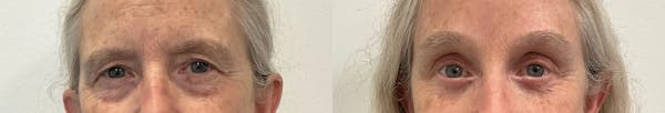 Eyelid Surgery Before & After Gallery - Patient 948790 - Image 1