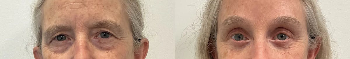 Eyelid Surgery Before & After Gallery - Patient 948790 - Image 1