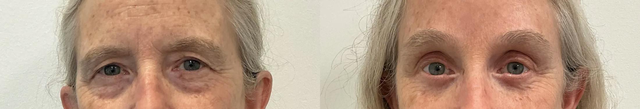 Eyelid Surgery Before & After Gallery - Patient 948790 - Image 1