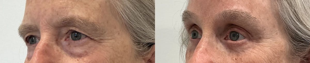 Eyelid Surgery Before & After Gallery - Patient 948790 - Image 2